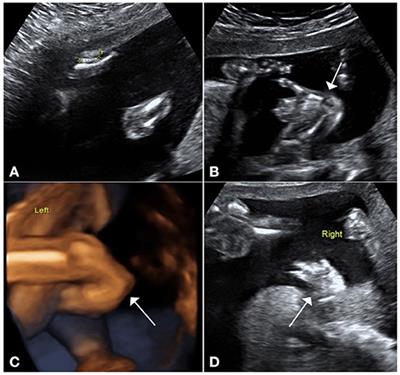 Prenatal Diagnosis of Holt–Oram Syndrome With a Novel Mutation of TBX5 Gene: A Case Report